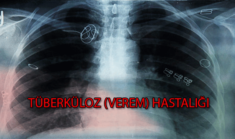 Tüberküloz (Verem Hastalığı) nedir?