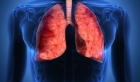 Akciğer Kanseri Nedir?